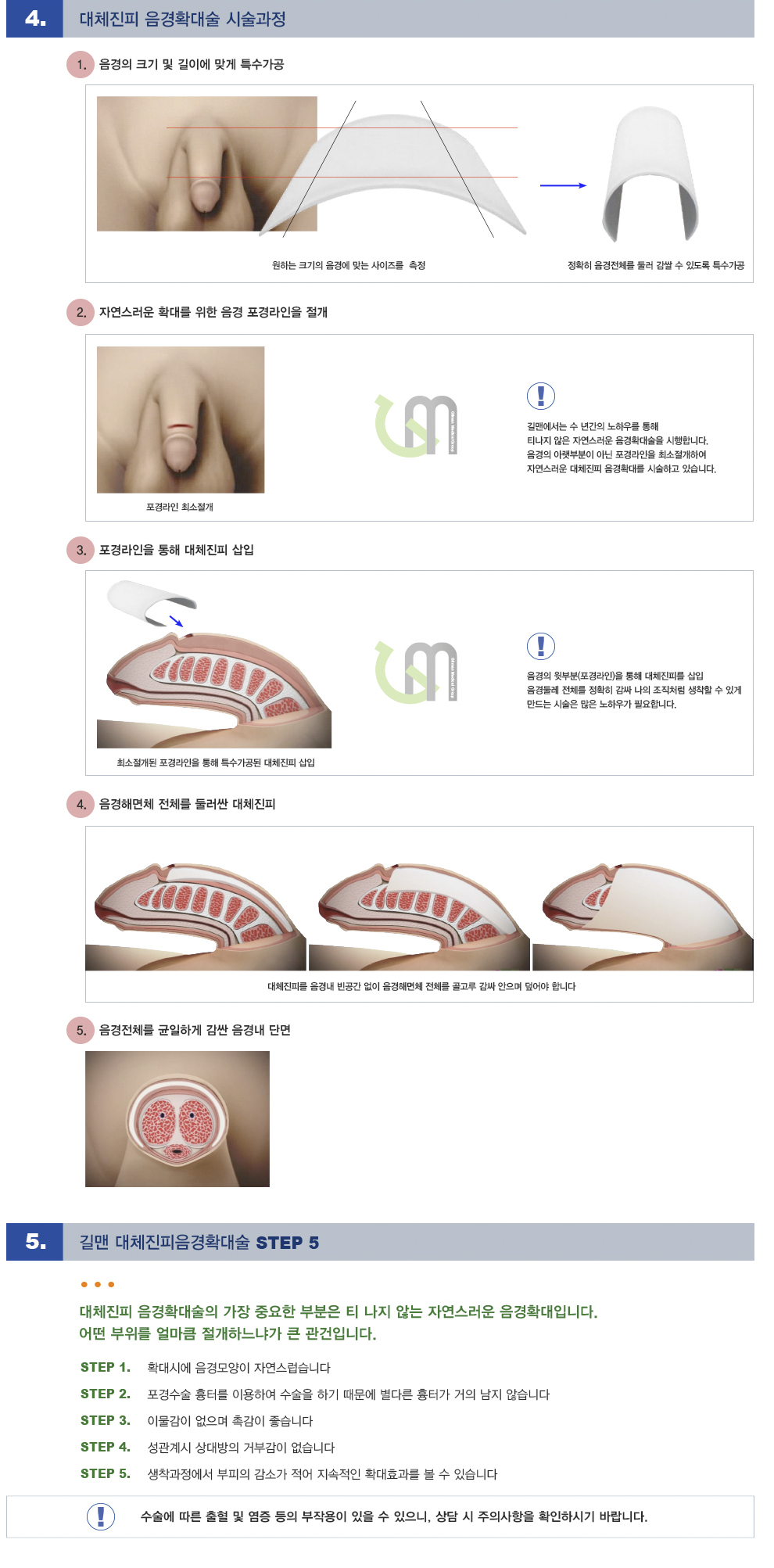 대체진피 음경확대