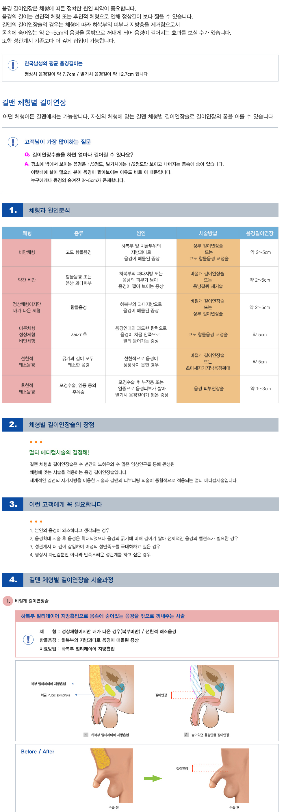 체형별 길이연장